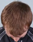 After Hair Transplant&nbsp;Hairlines
